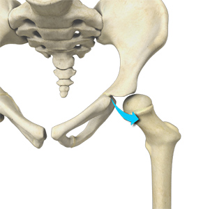 Developmental Dysplasia