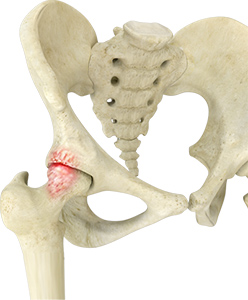 Hip Impingement