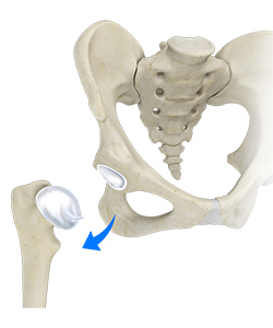 Surgical Dislocation