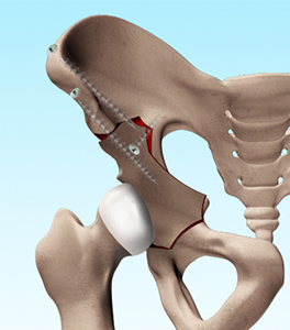Periacetabular Osteotomy