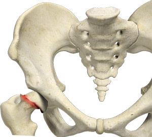 Slipped Capital Femoral Epiphysis