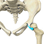Developmental Dysplasia