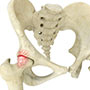 Hip Impingement
