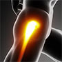 Hip Labrum Tear