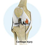 Knee Cartilage Injuries