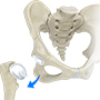 Surgical Dislocation