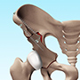 Periacetabular Osteotomy